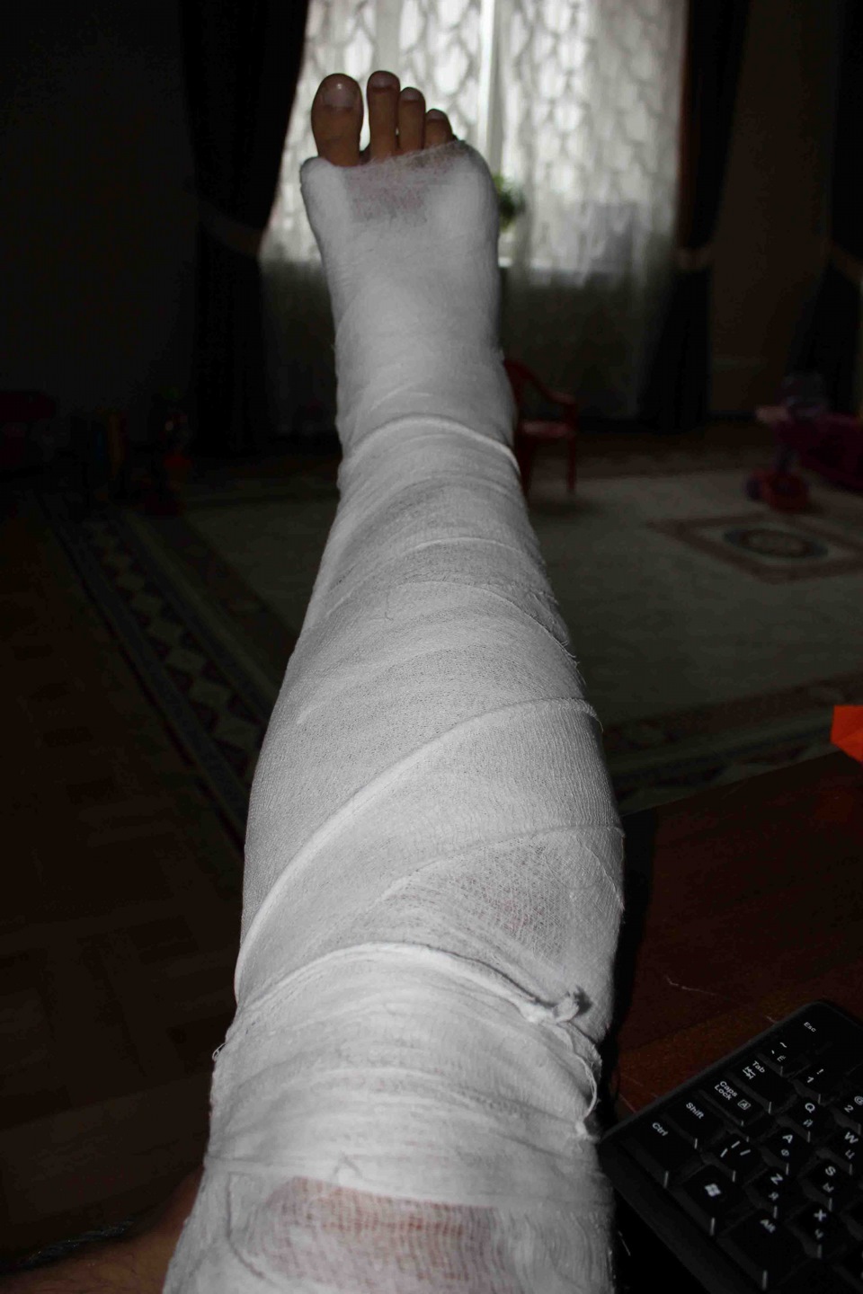 Фото Сломанной Ноги В Гипсе Девушки