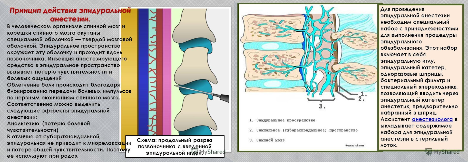 Эпидуральная спинная. Субарахноидальное пространство для спинальной анестезии. Анестезия спинного мозга субарахноидальное пространство. Спинальная и эпидуральная анестезия. Разница эпидуральной и спинномозговой анестезии.