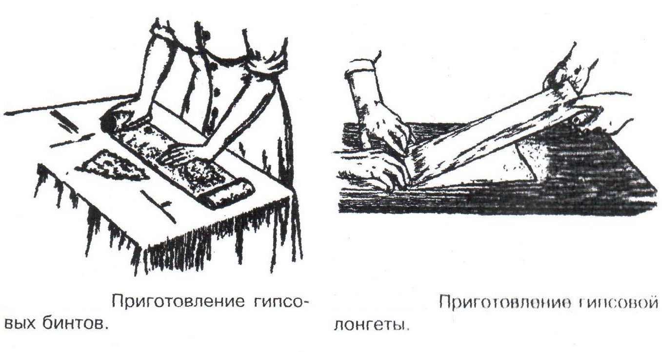 Нарабатываем опыт: гипсовая повязка — Сообщество «Первая Помощь  (03-112-911)» на DRIVE2