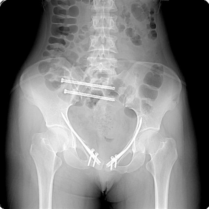 Трещина крестца. Несовершенный остеогенез кости таза рентген. Перелом тазовой кости рентген. Перелом костей таза рентгенограмма.