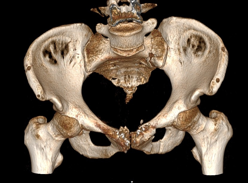 Кости ребенка фото. Чресацетабулярный перелом таза.