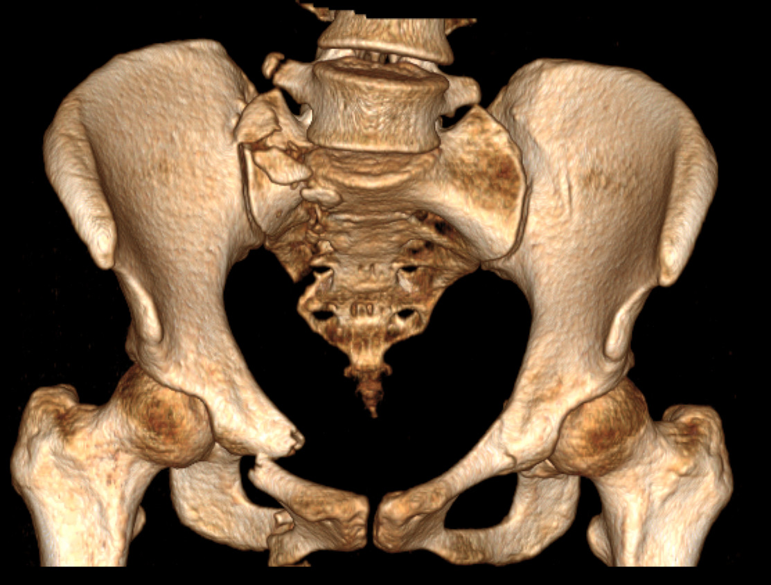 Спб костей. Перелом лонного сочленения. Кт костей таза перелом лонной кости.
