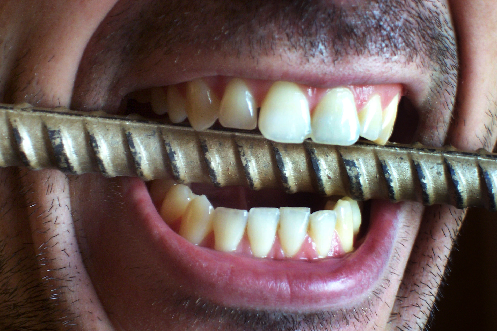 Больно стучать по зубу. Стираемость зубов бруксизм. Бруксизм скрежетание зубами.