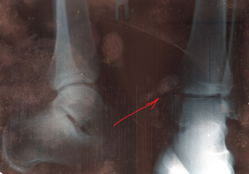 Перелом наружной латеральной лодыжки закрытый со смещением фото